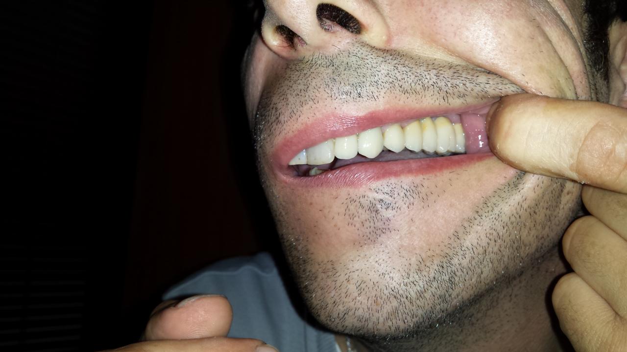 Quanto Costa Mettere Un Dente In Romania